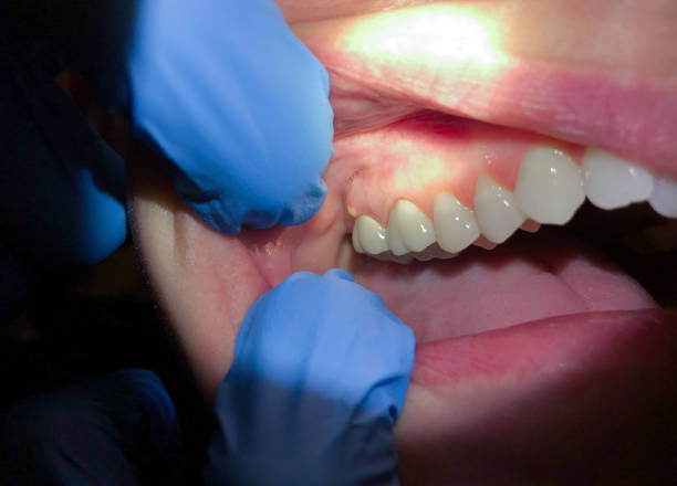 Best Broken or Chipped Tooth Repair in Walker Valley, NY